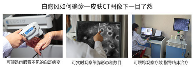 在体反射式共聚焦显微镜（三维皮肤CT）